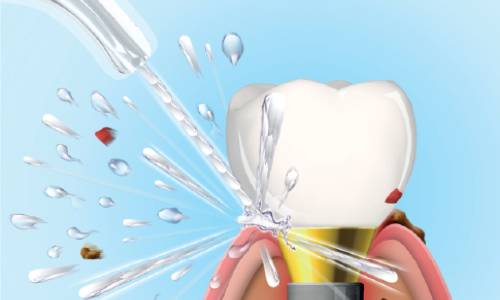 Prevents peri-implantitis
